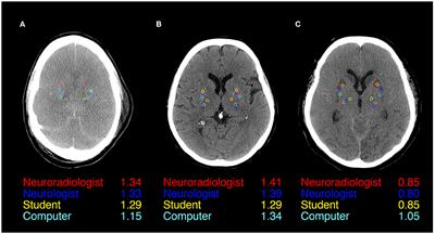 Inter-rater agreement between humans and computer in quantitative assessment of computed tomography after cardiac arrest